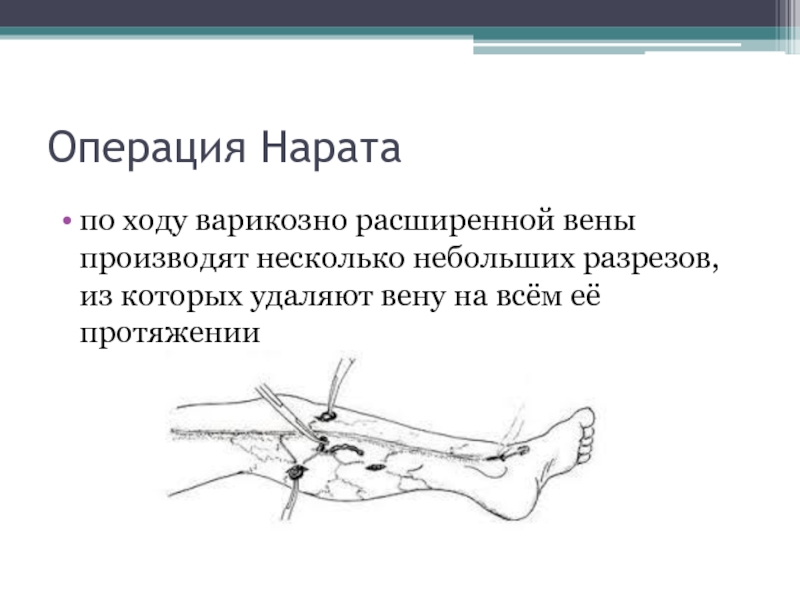 Варикоз Вен Операция