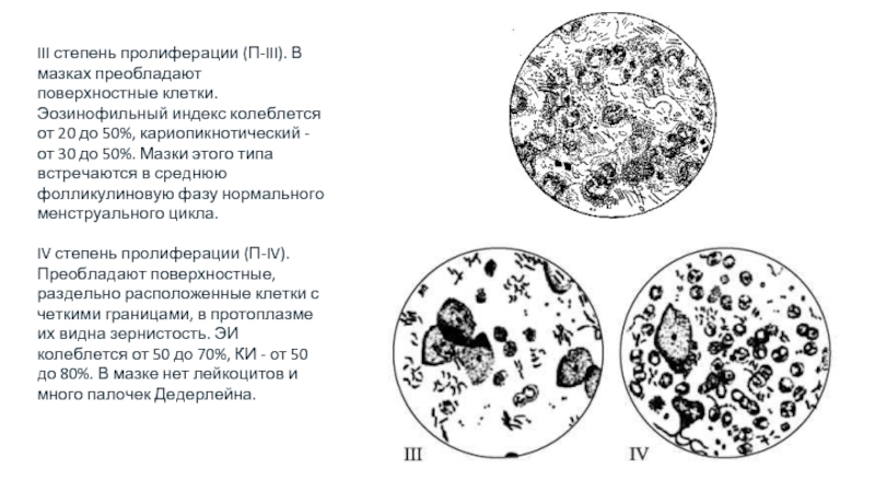 III степень пролиферации (П-III). В мазках преобладают поверхностные клетки. Эозинофильный индекс колеблется