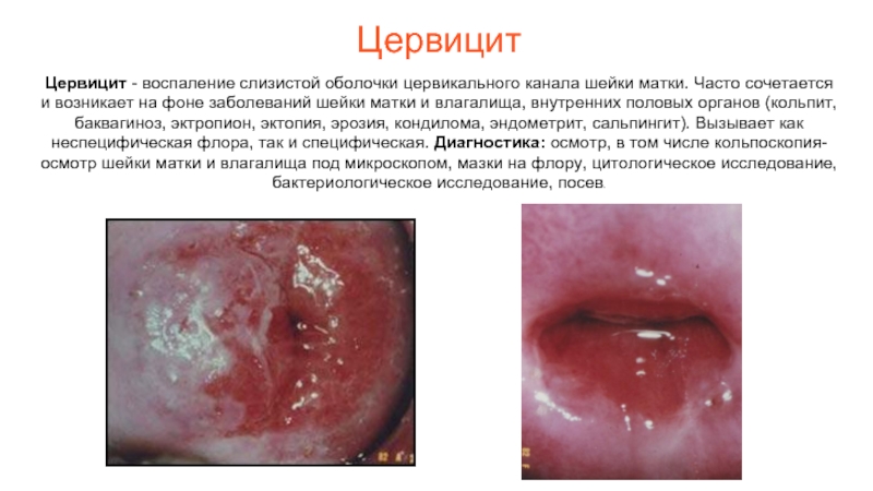 Цервицит Цервицит - воспаление слизистой оболочки цервикального канала шейки матки. Часто сочетается