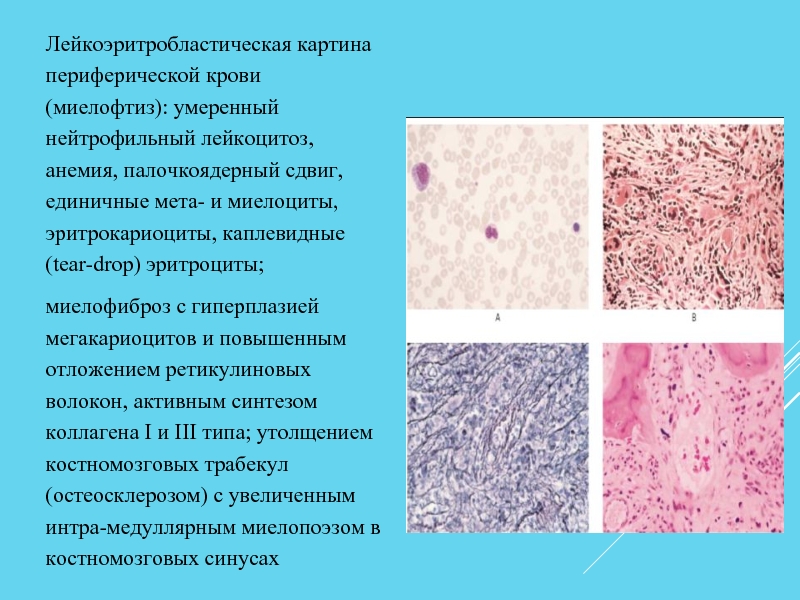 Лейкоэритробластическая картина периферической крови (миелофтиз): умеренный нейтрофильный лейкоцитоз, анемия, палочкоядерный сдвиг,