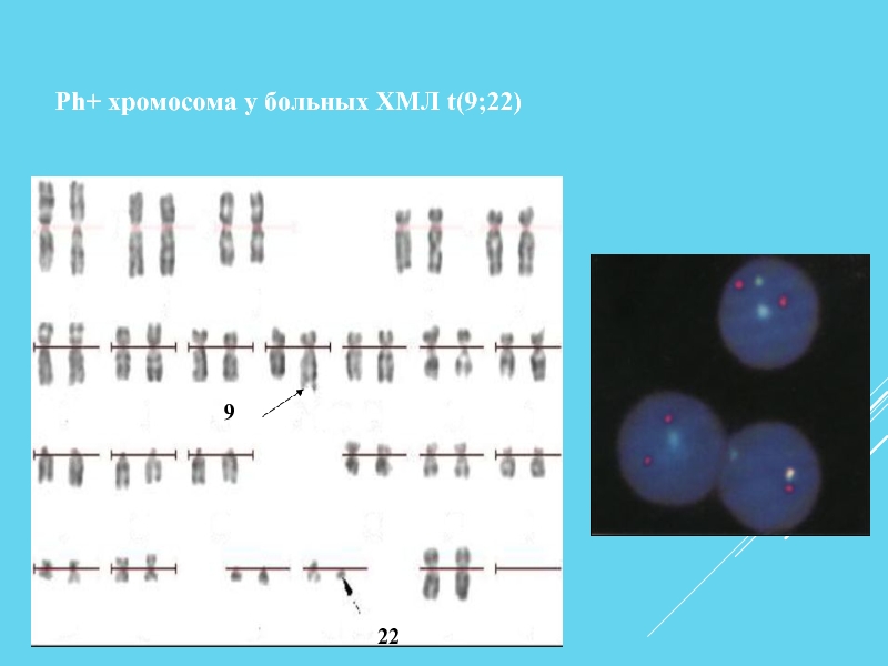 22  9  Ph+ хромосома у больных ХМЛ t(9;22)