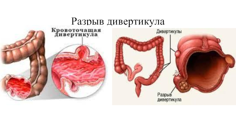 Dieta para diverticulos en el colon