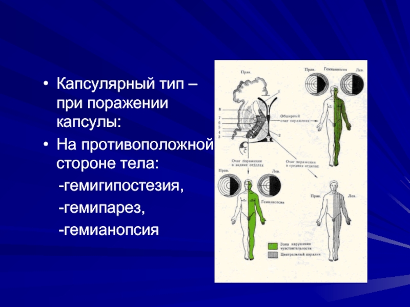 Стороны туловища. Капсулярный Тип поражения. Гемипарез при поражении внутренней капсулы. Левосторонний гемипарез очаг поражения. Гемипарез на противоположной стороне.