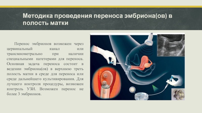 Методика проведения переноса эмбриона(ов) в полость матки   	Перенос эмбрионов возможен через