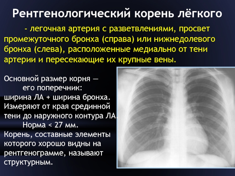 Корни легких усилены. Корень легкого это рентгенологическое. Рентген органов грудной клетки в двух проекциях. Корни легких в рентгенологии. Размеры корня легкого.