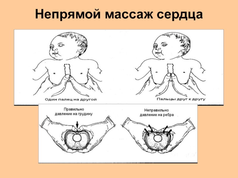 Непрямой сердца. Непрямой массаж сердца новорожденному. Непрямой массаж сердца у детей. Непрямой массаж сердца новорожденному алгоритм. Непрямой массаж сердца детям разного возраста.