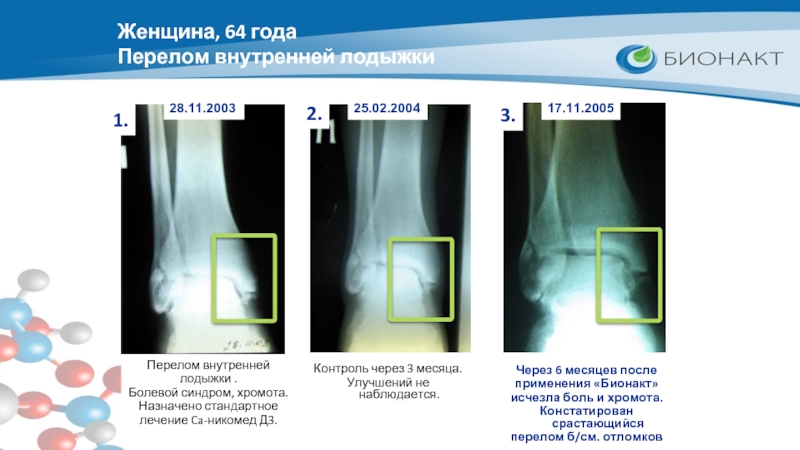 Перелом наружной лодыжки карта вызова скорой помощи