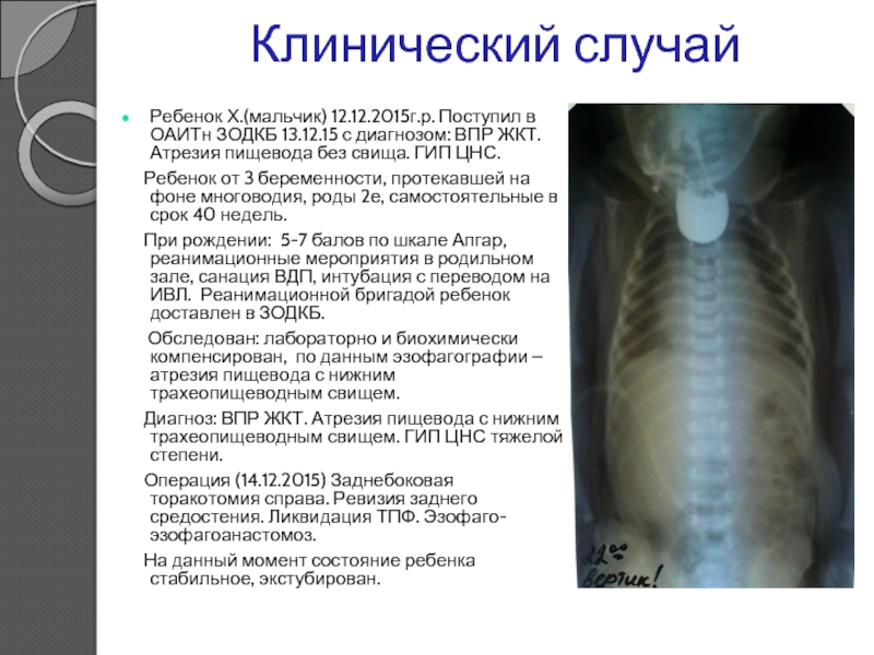 Атрезия пищевода у детей презентация