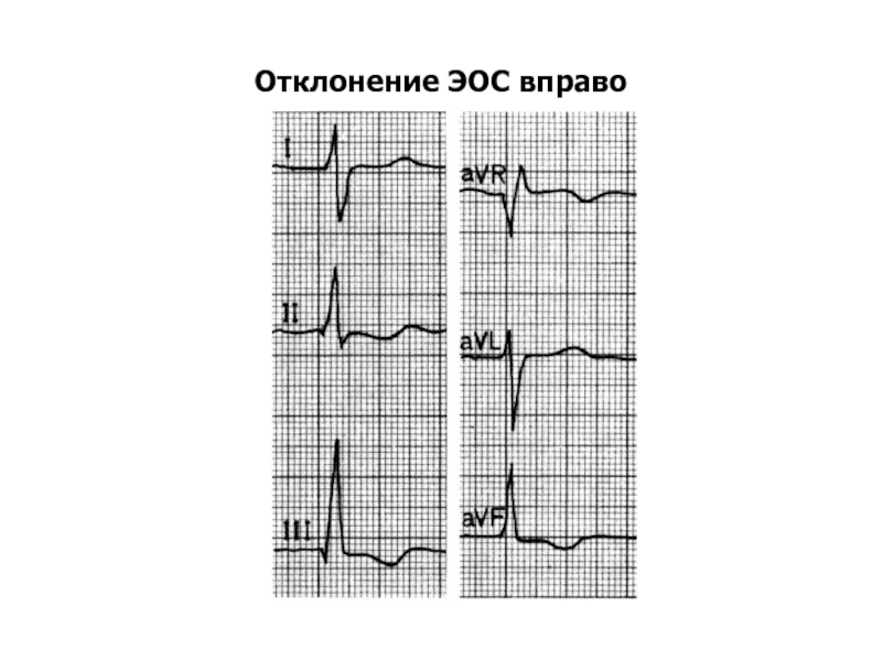 Сердце отклонено вправо. Отклонение оси вправо на ЭКГ. ЭКГ отклонение ЭОС влево тахикардия. ЭОС резко вправо на ЭКГ. Отклонение электрической оси вправо.