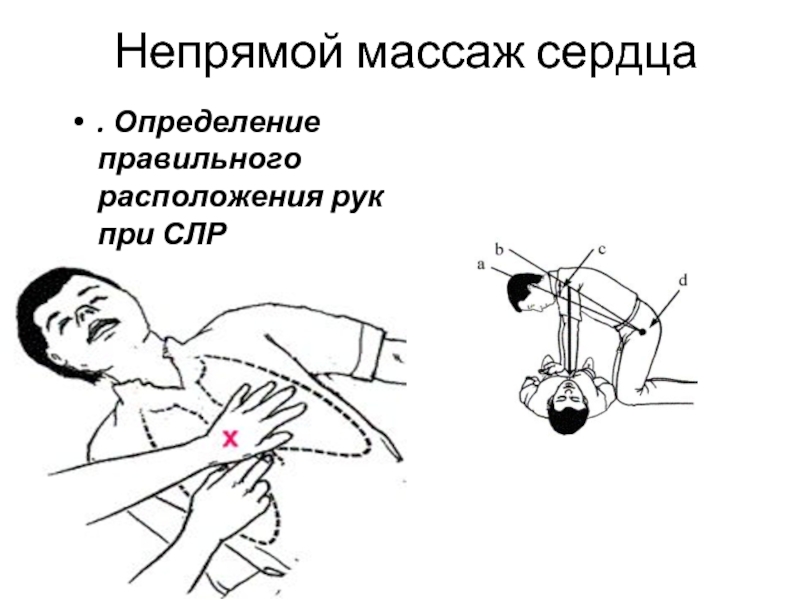 Непрямой массаж сердца при утоплении