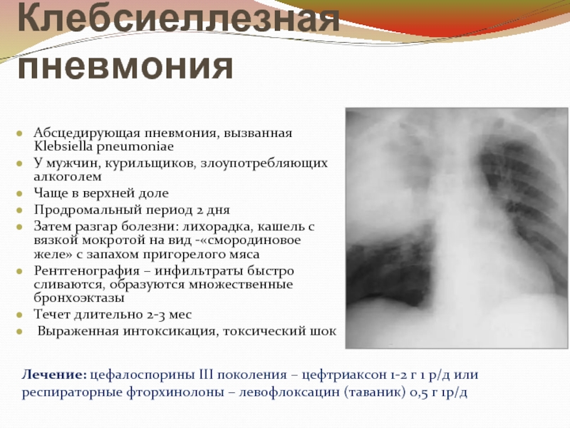 Пневмония симптомы без температуры с кашлем. Клебсиелла пневмония рентген. Абсцедирующая пневмония диагноз. Абсцедирующая пневмония рентген. Абсцедирующая пневмония на рентгенограмме.