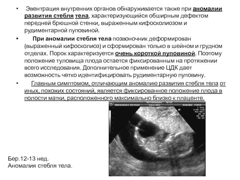 Эвентрация