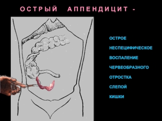 Острый аппендицит