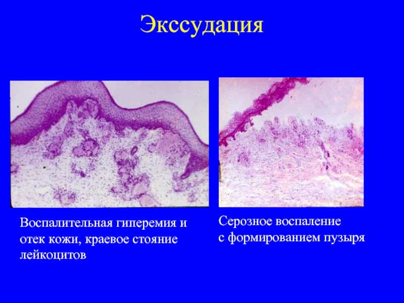 Экссудация Воспалительная гиперемия и отек кожи, краевое стояние лейкоцитовСерозное воспаление с формированием пузыря
