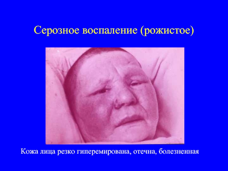 Серозное воспаление (рожистое)Кожа лица резко гиперемирована, отечна, болезненная