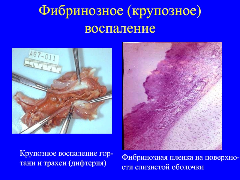 Фибринозное (крупозное)воспалениеКрупозное воспаление гор-тани и трахеи (дифтерия) Фибринозная пленка на поверхно-сти слизистой оболочки