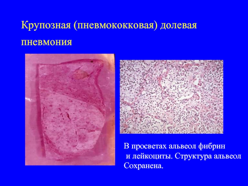 Крупозная (пневмококковая) долевая пневмония В просветах альвеол фибрин и лейкоциты. Структура альвеол Сохранена.