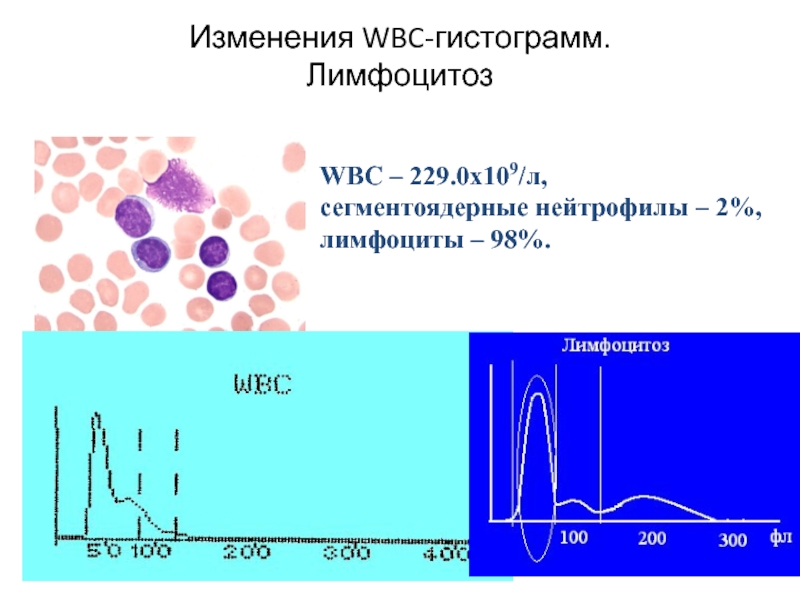 Изменения WBC-гистограмм. Лимфоцитоз  WBC – 229.0х109/л, сегментоядерные нейтрофилы – 2%,