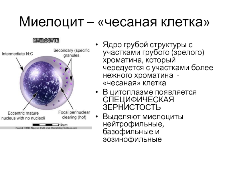 Миелоцит – «чесаная клетка» Ядро грубой структуры с участками грубого (зрелого) хроматина,