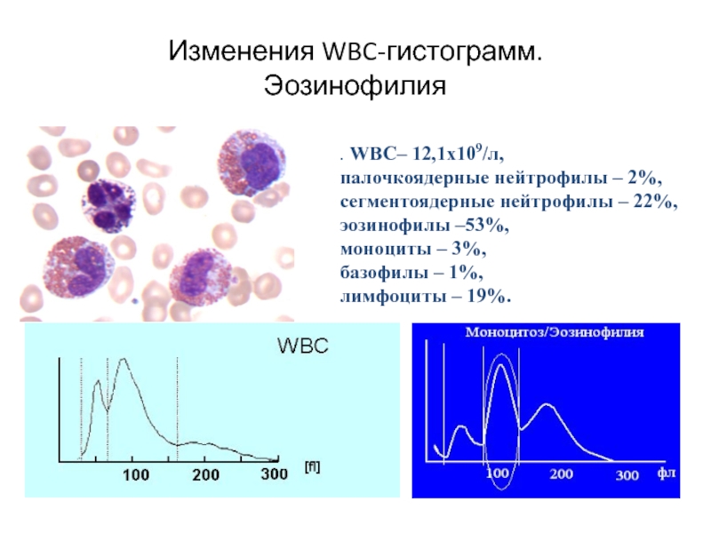 Изменения WBC-гистограмм. Эозинофилия . WBC– 12,1х109/л,  палочкоядерные нейтрофилы – 2%, сегментоядерные