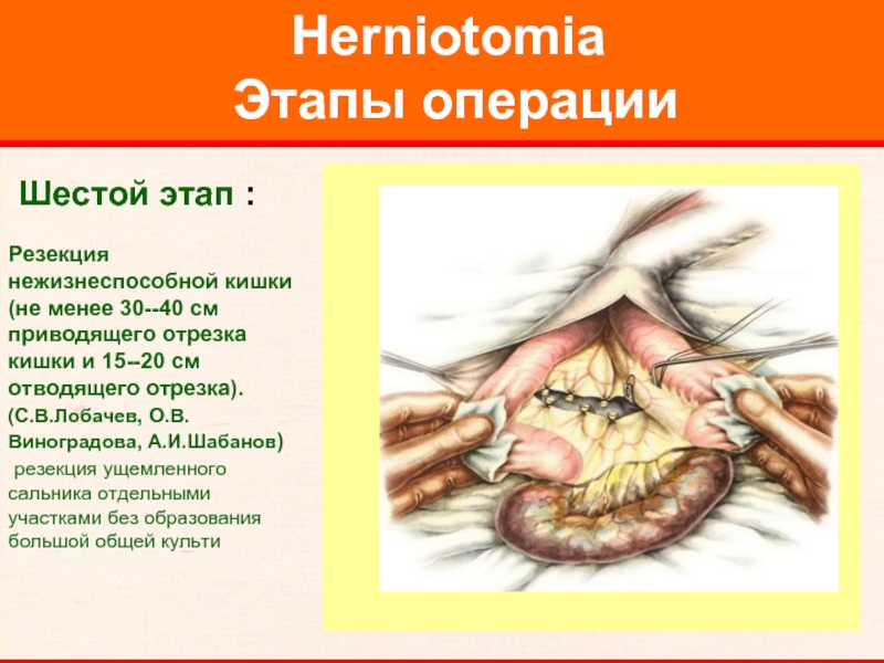 Herniotomia  Этапы операции     Шестой этап :