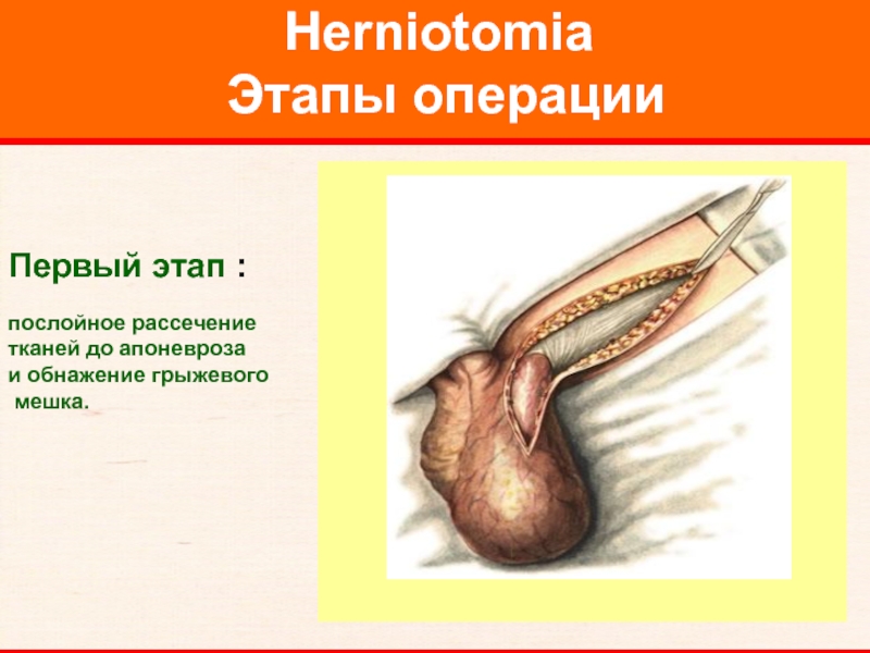 Herniotomia  Этапы операции    Первый этап :