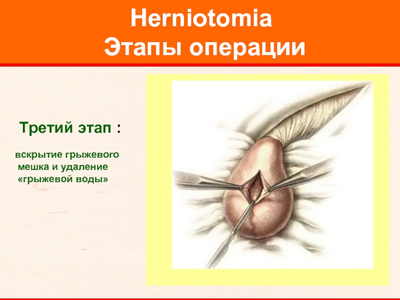Herniotomia  Этапы операции     Третий этап :