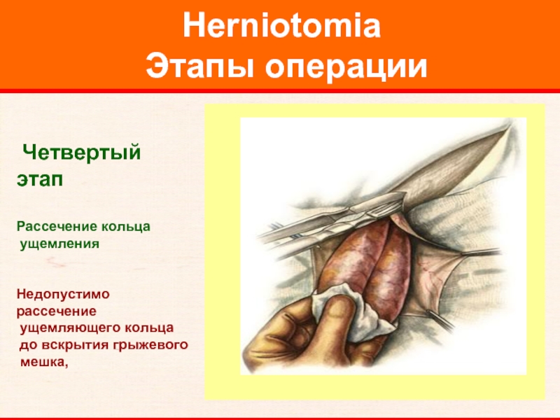 Herniotomia  Этапы операции     Четвертый этап