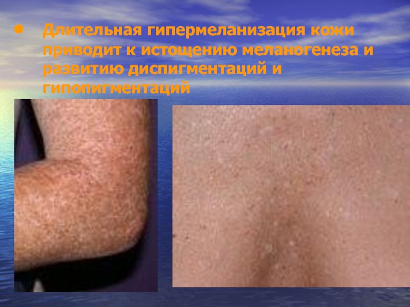 Длительная гипермеланизация кожи приводит к истощению меланогенеза и развитию диспигментаций и гипопигментаций