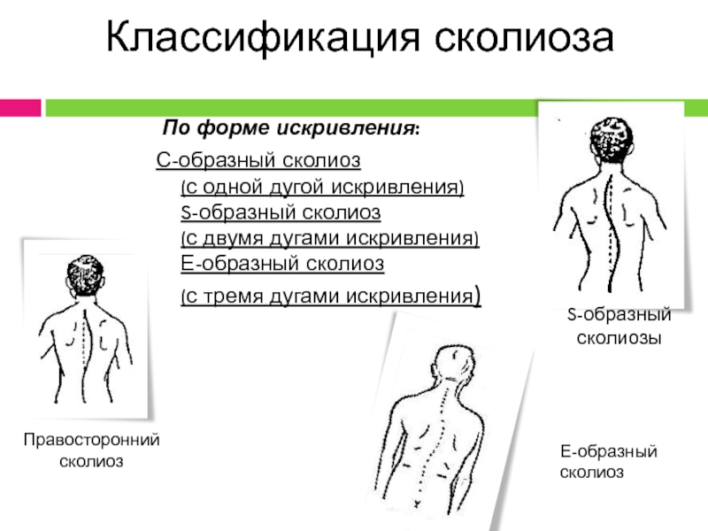 Нервно мышечный сколиоз клинические рекомендации