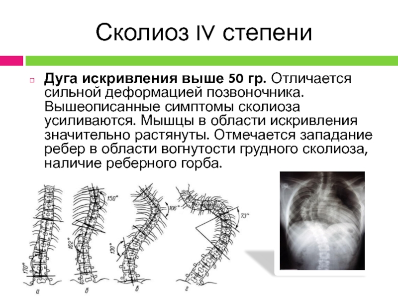 Симптомы сколиоза