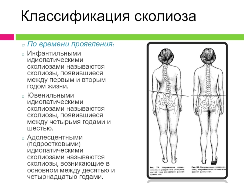 Клиническая картина сколиоз