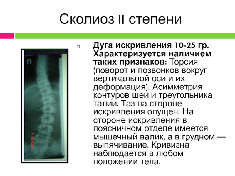 Сколиоз 2 степени. Искривление позвоночника 2 степени. Дугообразный сколиоз 2 степени. II степень сколиоза характеризуется. Фиксированный сколиоз 2 степени.