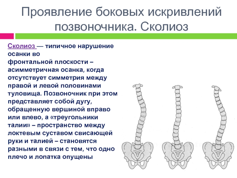 Сколиоз позвоночника презентация травматология