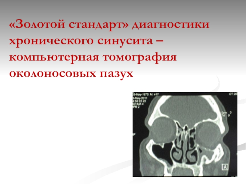 «Золотой стандарт» диагностики хронического синусита – компьютерная томография околоносовых пазух