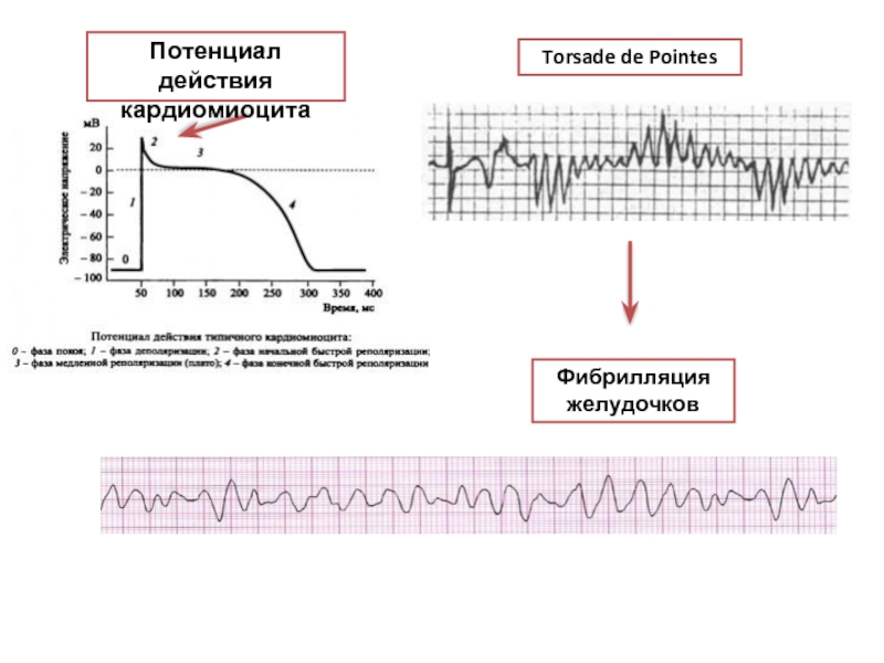 Потенциал действия кардиомиоцитаTorsade de PointesФибрилляция желудочков