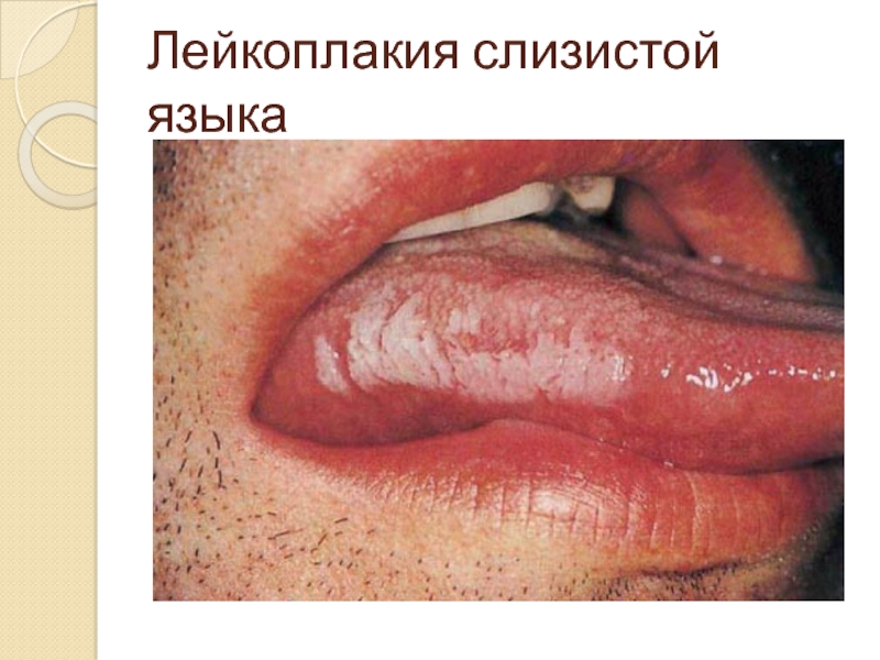 Лейкоплакия слизистой языка