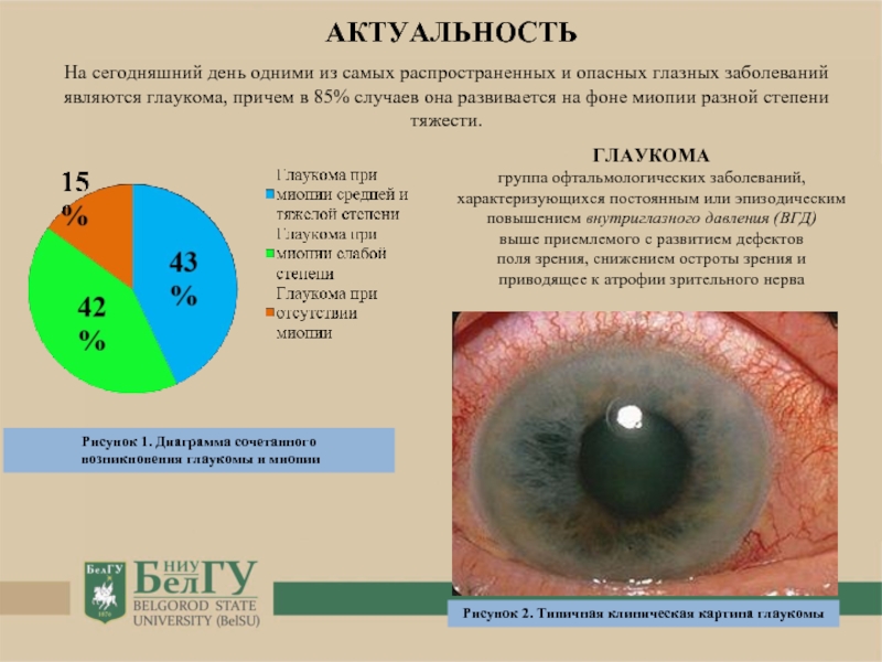 Рисунок 1. Диаграмма сочетанного возникновения глаукомы и миопииГЛАУКОМАгруппа офтальмологических заболеваний, характеризующихся