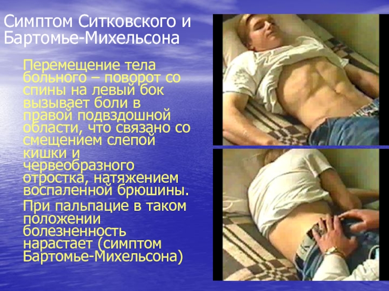Симптом Ситковского и Бартомье-МихельсонаПеремещение тела больного – поворот со спины на