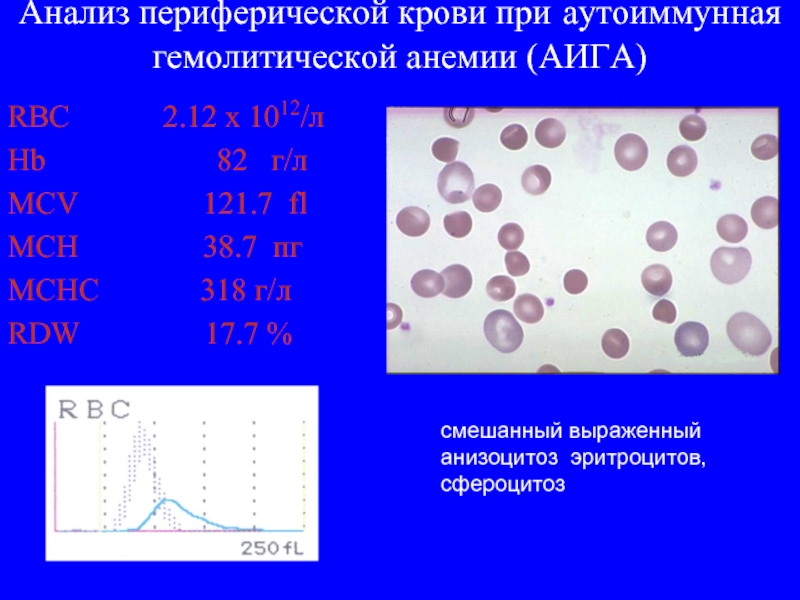 Анализ периферической крови при аутоиммунная гемолитической анемии (АИГА) RBC