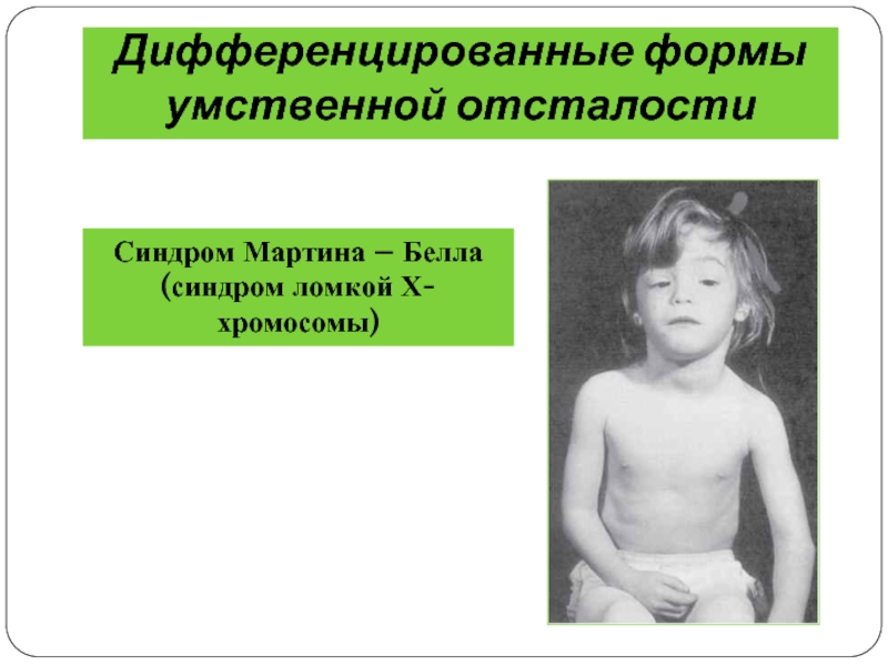 Дифференцированные формы умственной отсталостиСиндром Мартина – Белла(синдром ломкой Х- хромосомы)