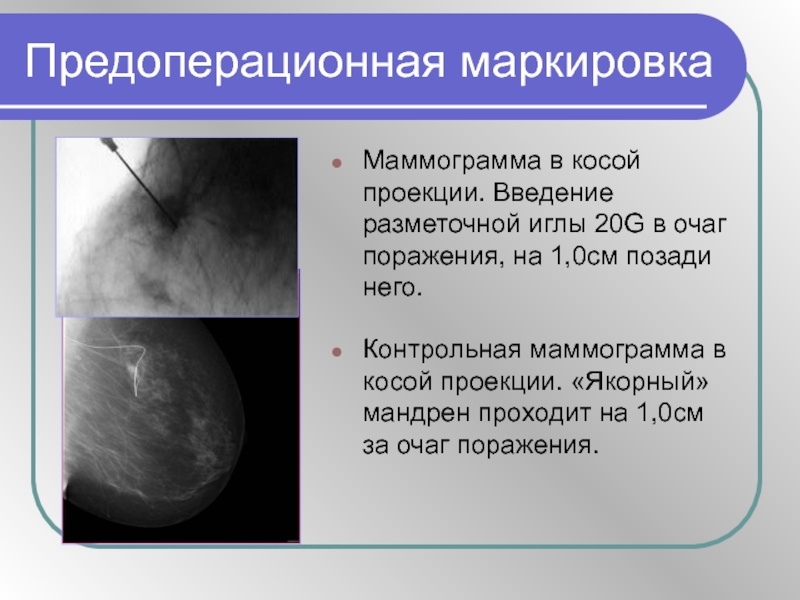 Маммография проекции. Косая проекция маммография. Маммография в косой проекции.