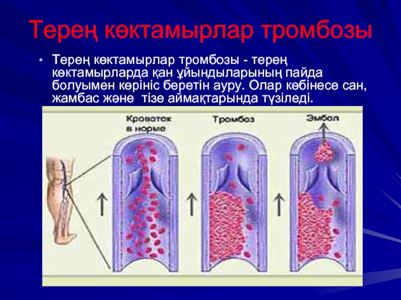Терең көктамырлар тромбозы - терең көктамырларда қан ұйындыларының пайда болуымен көрініс