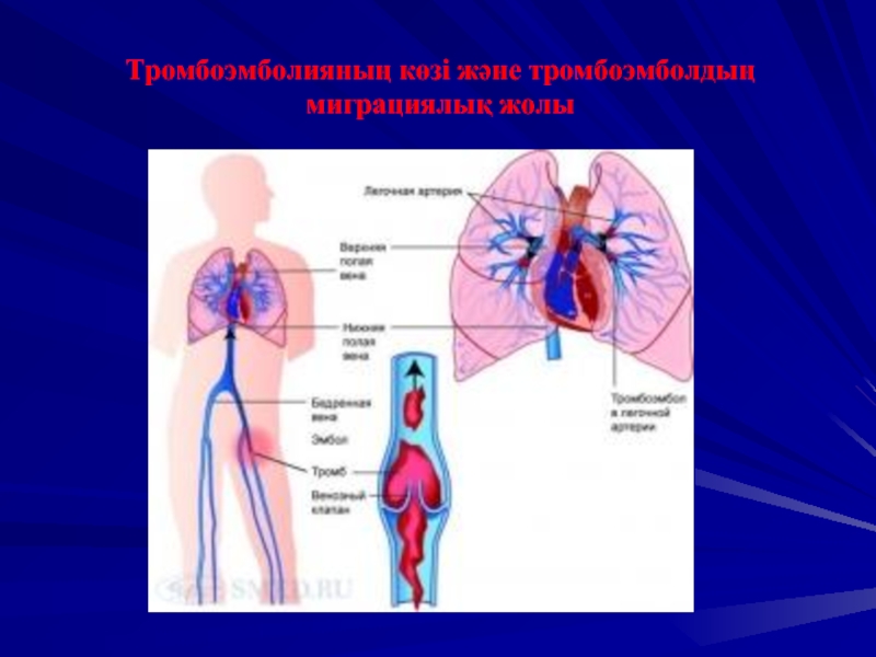 Тромбоэмболияның көзі және тромбоэмболдың миграциялық жолы
