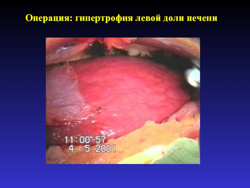 Операция: гипертрофия левой доли печени