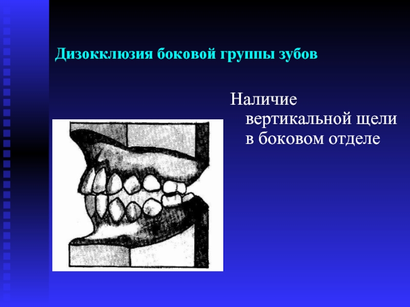 Дизокклюзия боковой группы зубов Наличие вертикальной щели в боковом отделе