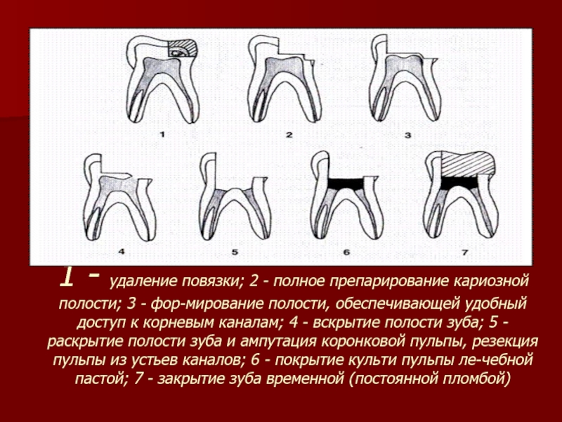 Кариозная полость сообщается с полостью зуба