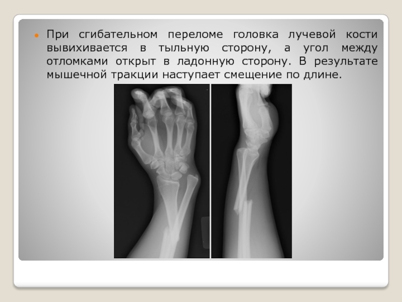 Перелом головки лучевой кости