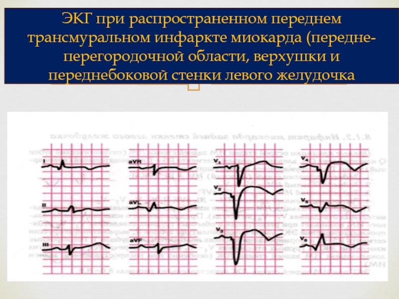 Изменение боковой стенки левого желудочка. Инфаркт миокарда передней стенки ЭКГ. Инфаркт миокарда переднебоковой стенки подострая стадия. Передний инфаркт миокарда на ЭКГ перегородки. Передне-перегородочный инфаркт миокарда на ЭКГ.