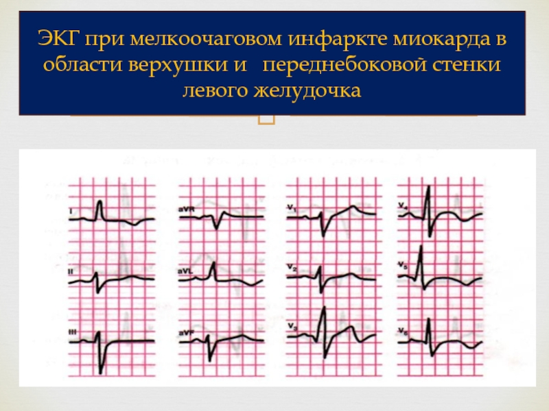 Как выглядит инфаркт на кардиограмме фото